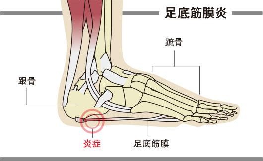 脚底穴位图讲解脚痛问题_和按摩鞋垫的好处!
